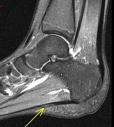 Figure 4 for case Juvenile plantar fibromatosis
